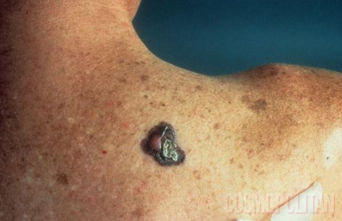 Rezultat tatujev iz sončnih opeklin je lahkko kožni rak